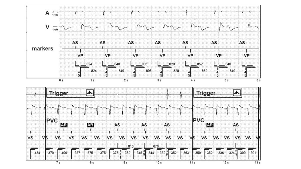 High ventricular rate - MicroPort Academy