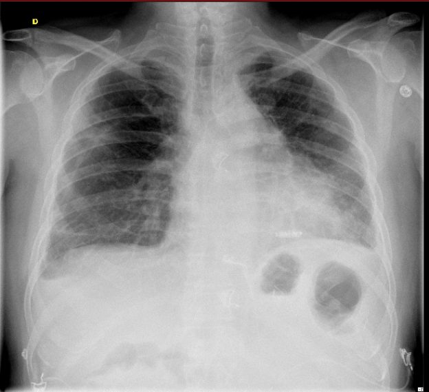 leadless pacemaker - MicroPort Academy