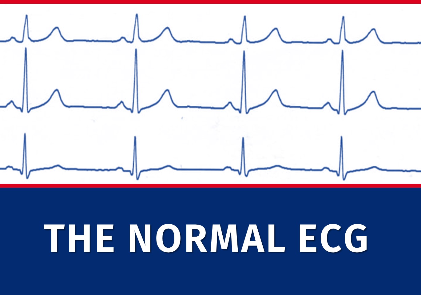 normal ecg