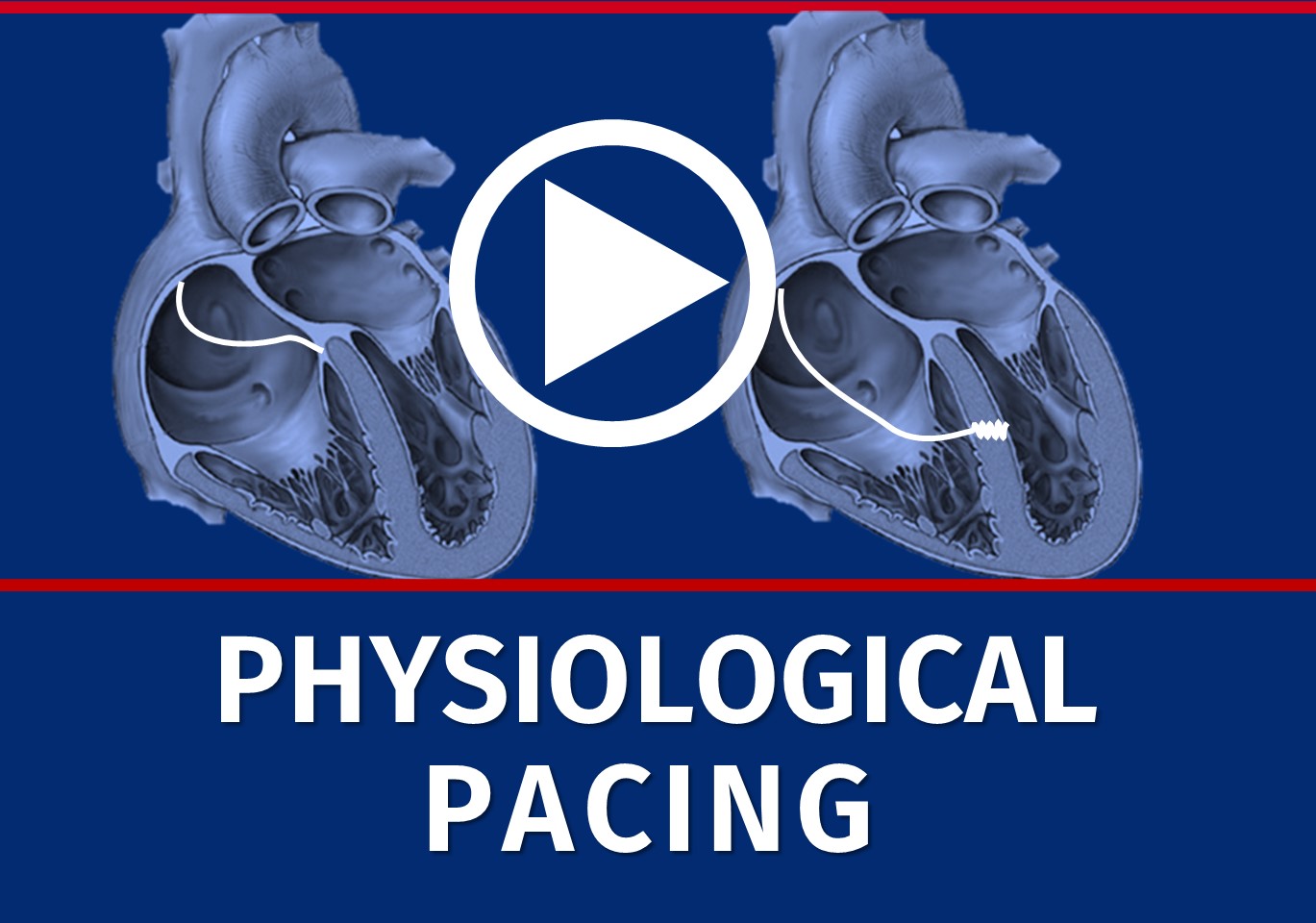 7. Physiological Pacing MicroPort Academy