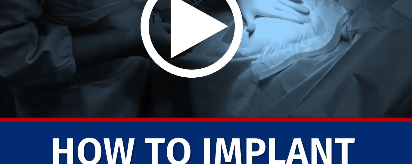3. How to implant an ICD